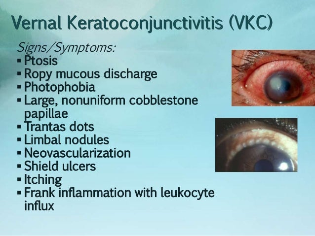 Evaluation of Red Eye; June 2014