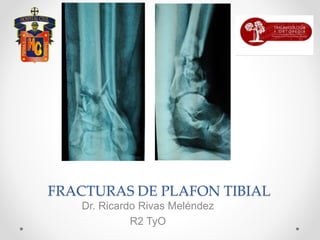 FRACTURAS DE PLAFON TIBIAL
Dr. Ricardo Rivas Meléndez
R2 TyO
 