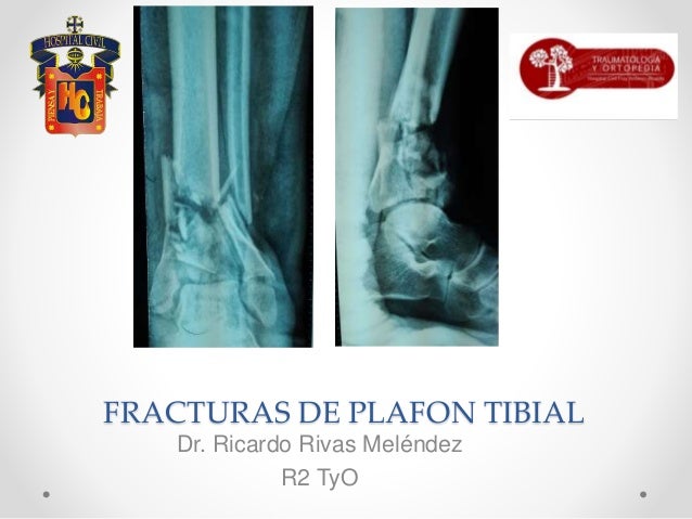 Ruedi Fracturas Plafon Tibial Articulo Original Ruedi Fracturas Plafon Tibial Articulo Original