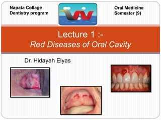 Dr. Hidayah Elyas
Lecture 1 :-
Red Diseases of Oral Cavity
Napata Collage
Dentistry program
Oral Medicine
Semester (9)
 