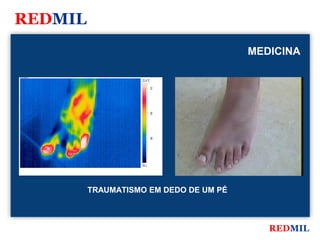 REDMIL
                                              MEDICINA

FLIR Systems


                          32.4 °C

                                    32




                                    30




                                    28




                          26.1




               TRAUMATISMO EM DEDO DE UM PÉ



                                                 REDMIL
 