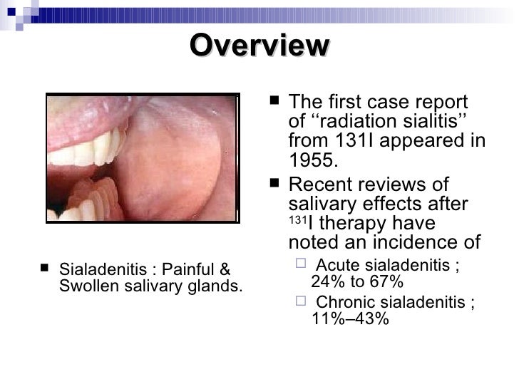 Reducing The Incidence Of 131i Induced Sialadenitis The Role Of Pil