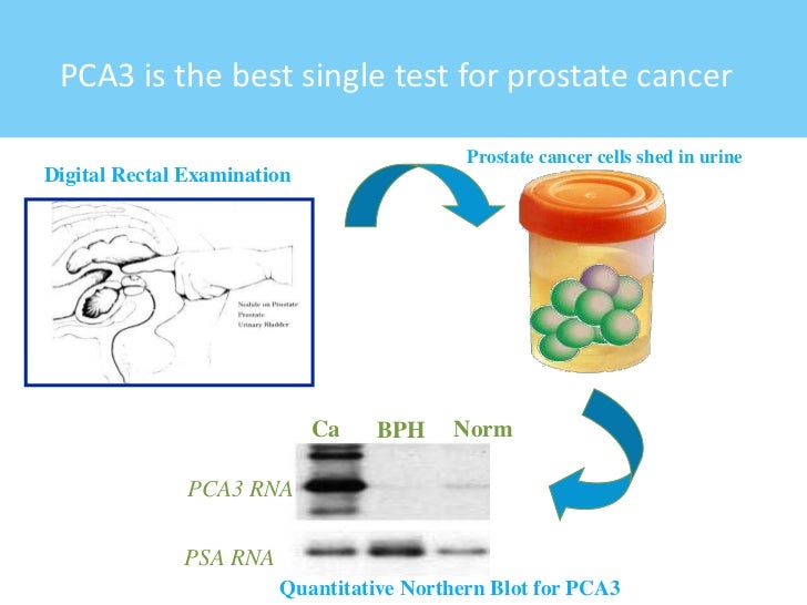 reducing-the-burden-of-prostate-cancer