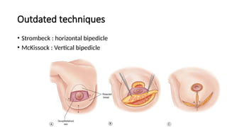 Reduction Mammaplasty procedure and post op management.pptx