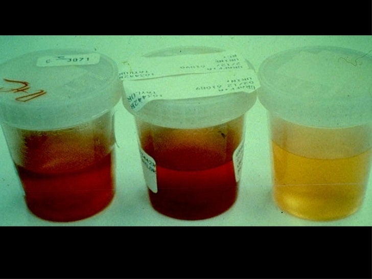 Red Urine