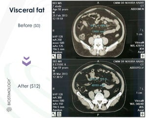 Before (S0)
After (S12)
Visceral fat
 