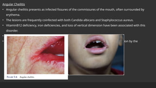 red & white disease of oral cavity...... | PPTX