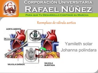 Reemplazo de válvula aortica
Yamileth solar
Johanna polindara
 