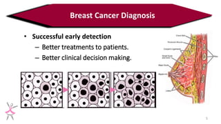 Breast Cancer Diagnosis using a Hybrid Genetic Algorithm for Feature ...