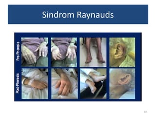 Sindrom Raynauds

10

 