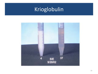 Krioglobulin

19

 