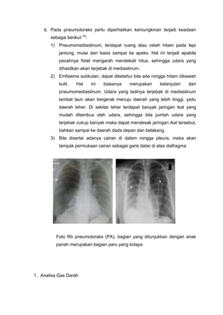 d. Pada pneumotoraks perlu diperhatikan kemungkinan terjadi keadaan
       sebagai berikut (3):
       1) Pneumomediastinum, terdapat ruang atau celah hitam pada tepi
           jantung, mulai dari basis sampai ke apeks. Hal ini terjadi apabila
           pecahnya fistel mengarah mendekati hilus, sehingga udara yang
           dihasilkan akan terjebak di mediastinum.
       2) Emfisema subkutan, dapat diketahui bila ada rongga hitam dibawah
           kulit.    Hal      ini   biasanya   merupakan   kelanjutan      dari
           pneumomediastinum. Udara yang tadinya terjebak di mediastinum
           lambat laun akan bergerak menuju daerah yang lebih tinggi, yaitu
           daerah leher. Di sekitar leher terdapat banyak jaringan ikat yang
           mudah ditembus oleh udara, sehingga bila jumlah udara yang
           terjebak cukup banyak maka dapat mendesak jaringan ikat tersebut,
           bahkan sampai ke daerah dada depan dan belakang.
       3) Bila disertai adanya cairan di dalam rongga pleura, maka akan
           tampak permukaan cairan sebagai garis datar di atas diafragma




          Foto Rö pneumotoraks (PA), bagian yang ditunjukkan dengan anak
          panah merupakan bagian paru yang kolaps




1. Analisa Gas Darah
 