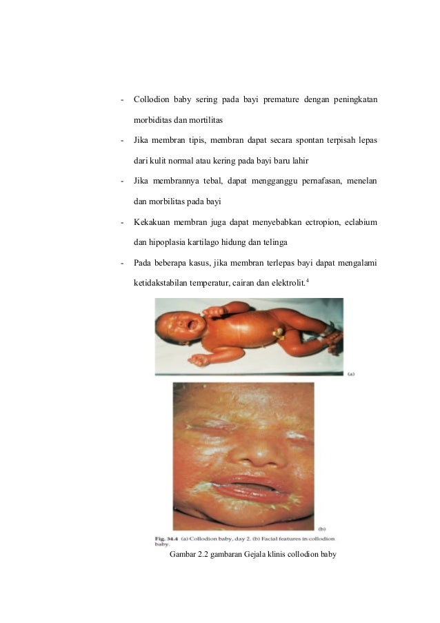 Referat Collodion Baby