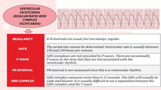 VENTRICULAR
TACHYCARDIA
(REGULAR/RAPID WIDE
COMPLEX
TACHYCARDIA)
 