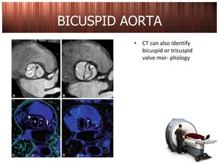 ct scan pada penyakit jantung katup | PPTX