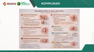 Referat tentang kista bartholini Obgyn.pdf