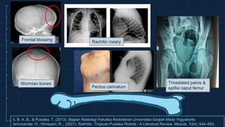 Orang Rakitis Referat Radiologi Rickets (Rakhitis) | PPTX