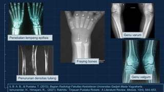 Referat Radiologi Rickets (Rakhitis) | PPTX