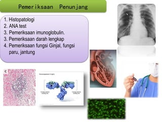 1. Histopatologi
2. ANA test
3. Pemeriksaan imunoglobulin.
3. Pemeriksaan darah lengkap
4. Pemeriksaan fungsi Ginjal, fungsi
paru, jantung
Pemeriksaan Penunjang
 