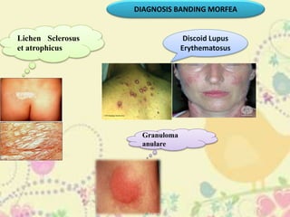 DIAGNOSIS BANDING MORFEA
Lichen Sclerosus
et atrophicus
Discoid Lupus
Erythematosus
Granuloma
anulare
 