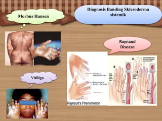 Diagnosis Banding Skleroderma
sistemikMorbus Hansen
Raynaud
Disease
Vitiligo
 