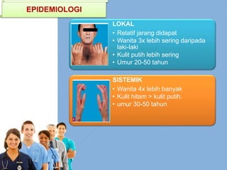 LOKAL
• Relatif jarang didapat
• Wanita 3x lebih sering daripada
laki-laki
• Kulit putih lebih sering
• Umur 20-50 tahun
SISTEMIK
• Wanita 4x lebih banyak
• Kulit hitam > kulit putih.
• umur 30-50 tahun
EPIDEMIOLOGI
 