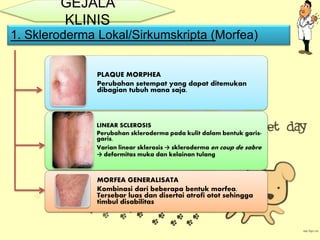 GEJALA
KLINIS
1. Skleroderma Lokal/Sirkumskripta (Morfea)
PLAQUE MORPHEA
Perubahan setempat yang dapat ditemukan
dibagian tubuh mana saja.
LINEAR SCLEROSIS
Perubahan skleroderma pada kulit dalam bentuk garis-
garis.
Varian linear sklerosis → skleroderma en coup de sabre
→ deformitas muka dan kelainan tulang
MORFEA GENERALISATA
Kombinasi dari beberapa bentuk morfea.
Tersebar luas dan disertai atrofi otot sehingga
timbul disabilitas
 