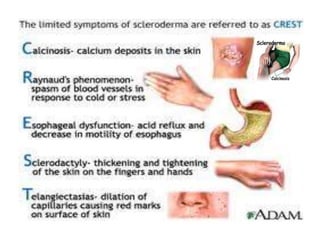 Referat skleroderma