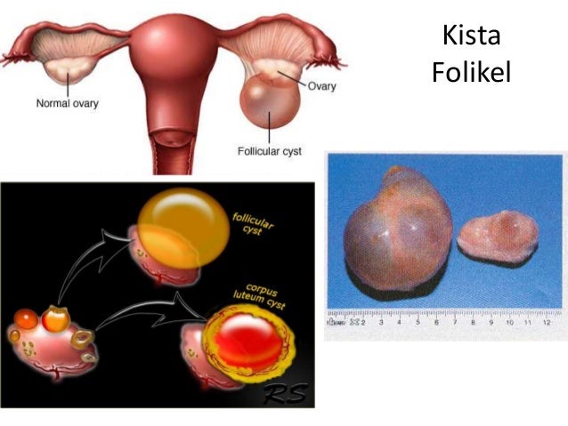 Referat tumor ovarium (ppt)
