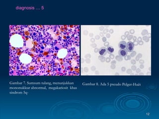 diagnosis … 5 Gambar 7. Sumsum tulang, menunjukkan mononuklear  abnormal,  megakariosit  khas sindrom 5q-  Gambar 8. Ada 5 pseudo Pelger-Huët 