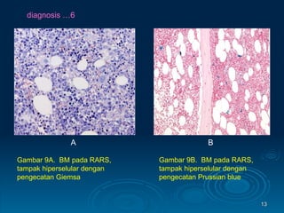 diagnosis …6 Gambar 9A.  BM pada RARS, tampak hiperselular dengan pengecatan Giemsa  B A Gambar 9B.  BM pada RARS, tampak hiperselular dengan pengecatan Prussian blue  