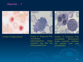 diagnosis … 7 Gambar 11. Pengecatan PAS, menunjukkan mikromegakariosit dengan sitoplasma yang difus dan beberapa granul kasar. Gambar 12. Pengecatan PAS, menunjukkan diseritropoiesis dengan normoblas trinukleate dan granular kasar pada proerithroblast. Gambar 10.  Ringed sideroblast   