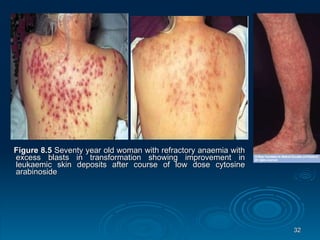 Figure 8.5  Seventy year old woman with refractory anaemia with excess blasts in transformation showing improvement in leukaemic skin deposits after course of low dose cytosine arabinoside 