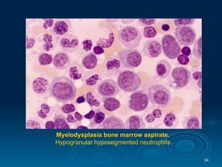 Myelodysplasia bone marrow aspirate. Hypogranular hyposegmented neutrophils. 