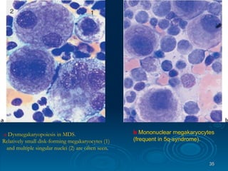 a   Dysmegakaryopoiesis in MDS.  Relatively small disk-forming megakaryocytes (1) and multiple singular nuclei (2) are often seen .  b   Mononuclear megakaryocytes  (frequent in 5q-syndrome). 
