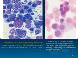 c   Dyserythropoiesis. Particularly striking is the coarse nuclear structure with very light gaps in the chromatin  (arrow 1). Some are megaloblast-like but coarser (arrow2).  d   Iron staining of the bone marrow  (Prussian blue) inmyelodysplasia of the RARS type: dense iron granules  forming a partial ring around the nuclei  (ring sideroblasts). 