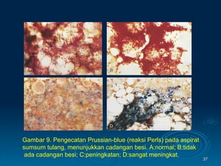 Gambar 9. Pengecatan Prussian-blue (reaksi Perls) pada aspirat sumsum tulang, menunjukkan cadangan besi.  A:normal; B:tidak ada cadangan besi; C:peningkatan; D:sangat meningkat. 