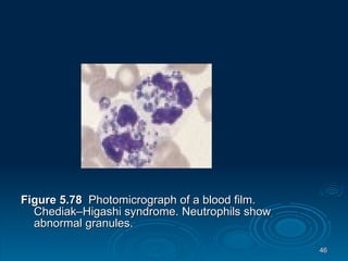 Figure 5.78   Photomicrograph of a blood film. Chediak–Higashi syndrome. Neutrophils show abnormal granules.  