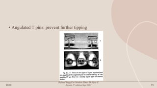• Angulated T pins: prevent further tipping
20XX
Refined Begg For Modern Times.Dr.Vijay P.
Jayade.1st edition.Sept.2001 73
 