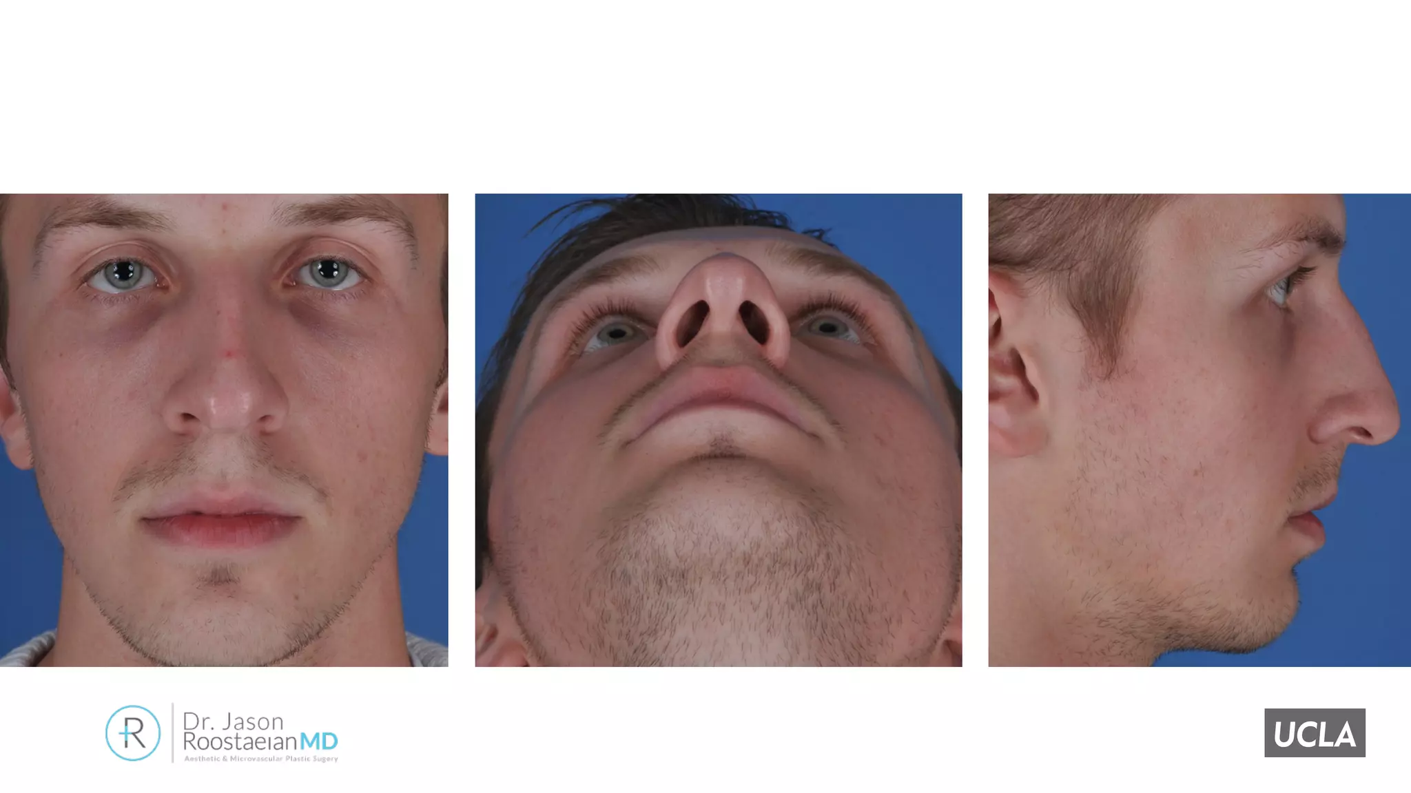 Refinements and advances in rhinoplasty with alar contour grafts | PDF