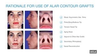 Refinements and advances in rhinoplasty with alar contour grafts | PDF