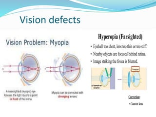 Vision defects
 