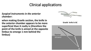 Clinical applications
Surgical instruments in the anterior
chamber:
when making Graefe section, the knife in
the anterior chamber appears to be more
superficial than it really is (therefore the
point of the knife is aimed at the opposite
limbus to emerge 1 mm behind the
limbus)
Graefe knife in AC
 