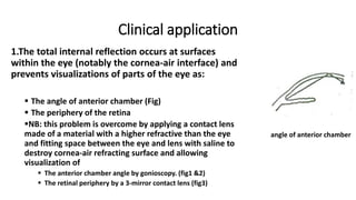 Clinical application
1.The total internal reflection occurs at surfaces
within the eye (notably the cornea-air interface) and
prevents visualizations of parts of the eye as:
 The angle of anterior chamber (Fig)
 The periphery of the retina
NB: this problem is overcome by applying a contact lens
made of a material with a higher refractive than the eye
and fitting space between the eye and lens with saline to
destroy cornea-air refracting surface and allowing
visualization of
 The anterior chamber angle by gonioscopy. (fig1 &2)
 The retinal periphery by a 3-mirror contact lens (fig3)
angle of anterior chamber
 