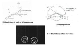 1) Visualization of angle of AC by goniolens
2) Koeppe goniolens
3) Goldmann three or four mirror lens
 