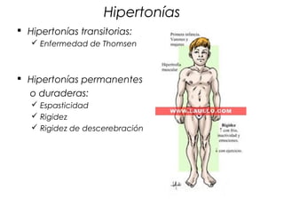 Hipertonías
 Hipertonías transitorias:
    Enfermedad de Thomsen



 Hipertonías permanentes
  o duraderas:
    Espasticidad
    Rigidez
    Rigidez de descerebración
 
