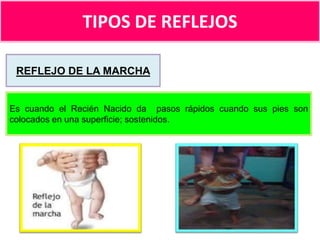 TIPOS DE REFLEJOS
REFLEJO DE LA MARCHA

Es cuando el Recién Nacido da pasos rápidos cuando sus pies son
colocados en una superficie; sostenidos.

 