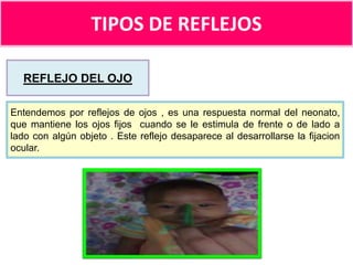TIPOS DE REFLEJOS
REFLEJO DEL OJO
Entendemos por reflejos de ojos , es una respuesta normal del neonato,
que mantiene los ojos fijos cuando se le estimula de frente o de lado a
lado con algún objeto . Este reflejo desaparece al desarrollarse la fijacion
ocular.

 