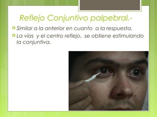 Reflejo Conjuntivo palpebral.-
 Similar a la anterior en cuanto a la respuesta.
 La vías y el centro reflejo, se obtiene estimulando
la conjuntiva.
 