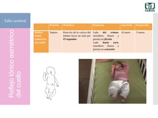 Reflejotónicoasimétrico
delcuelloTallo cerebral
Posición Maniobra Respuesta Aparición Integración
Reflejo
tónico
asimétrico
del cuello
Supino Rotación de la cabeza del
infante hacia un lado por
15 segundos
Lado del cráneo:
miembros (brazo y
pierna) en flexión
Lado hacia cara:
miembros (brazo y
pierna) en extensión
Al nacer 3 meses
 